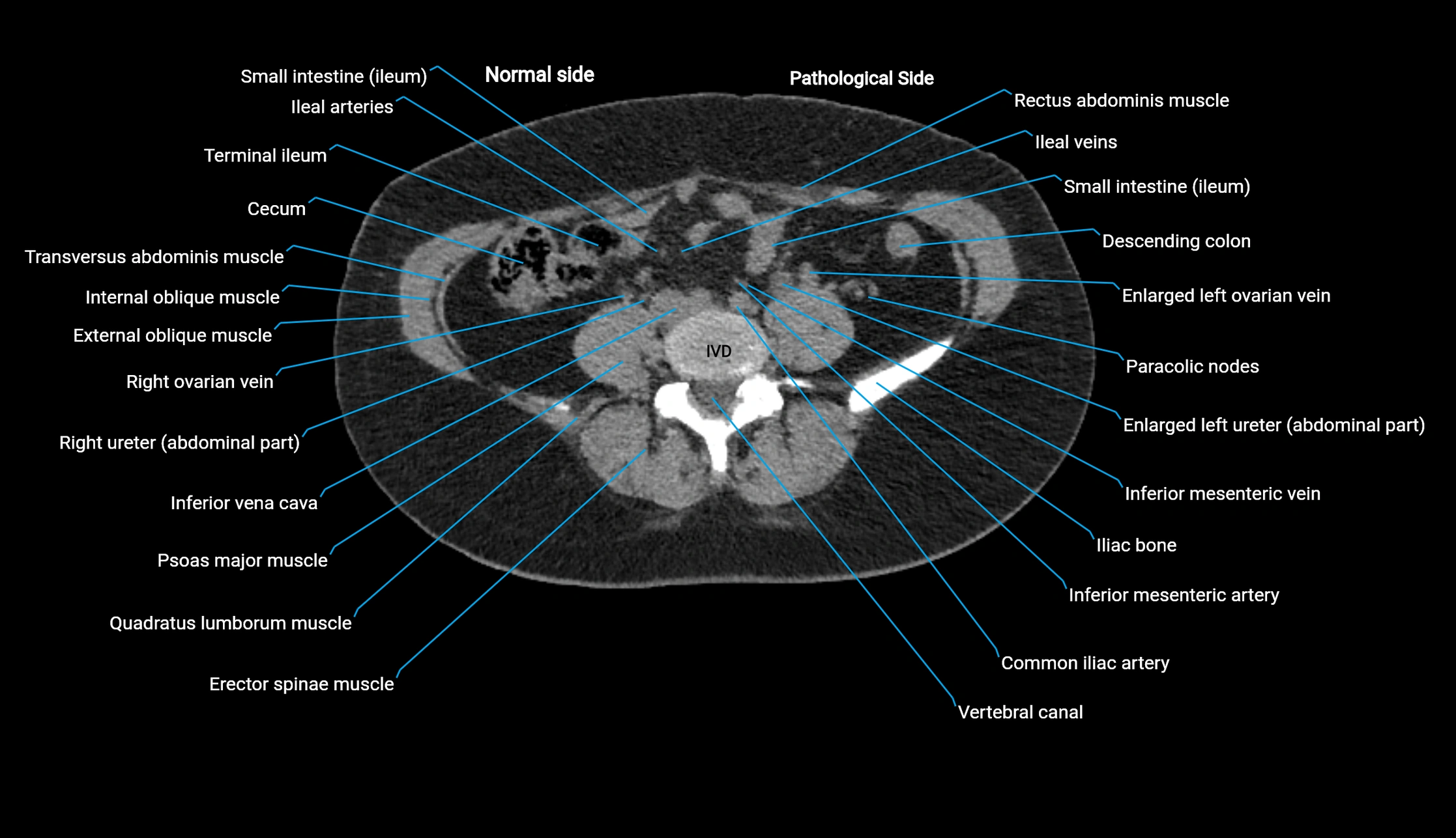 CT KUB axial cross sectional anatomy  radiology image -img-00201-00095.webp